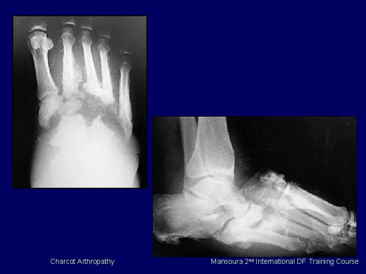 Charcot Arthropathy Mansoura 2 nd International DF Training Course 