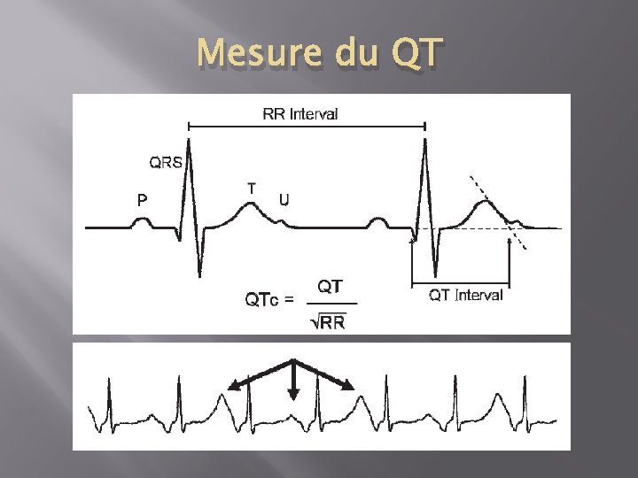 Mesure du QT 