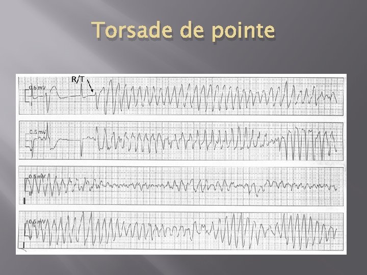 Torsade de pointe 