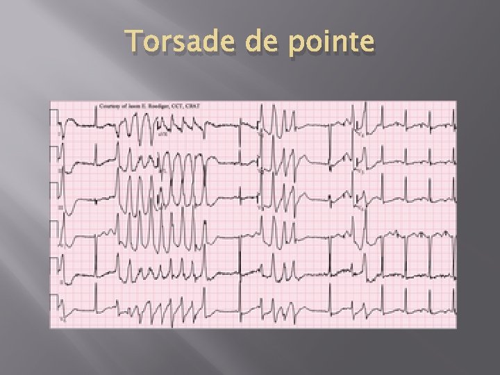 Torsade de pointe 