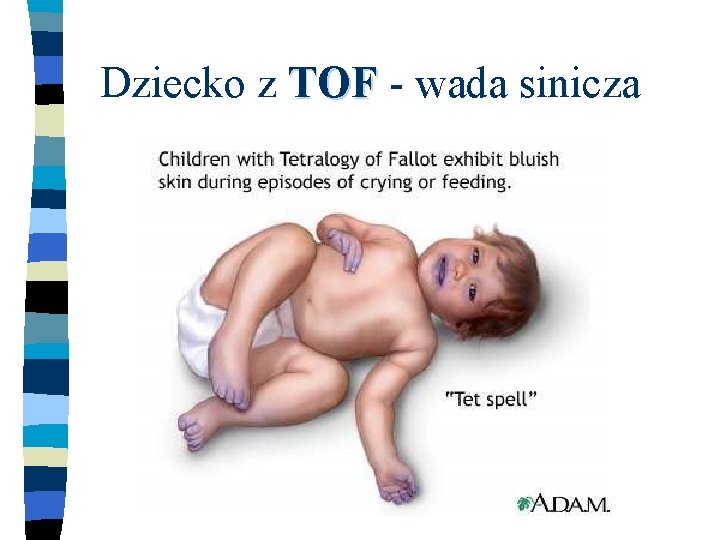 Dziecko z TOF - wada sinicza 