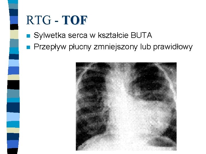 RTG - TOF n n Sylwetka serca w kształcie BUTA Przepływ płucny zmniejszony lub