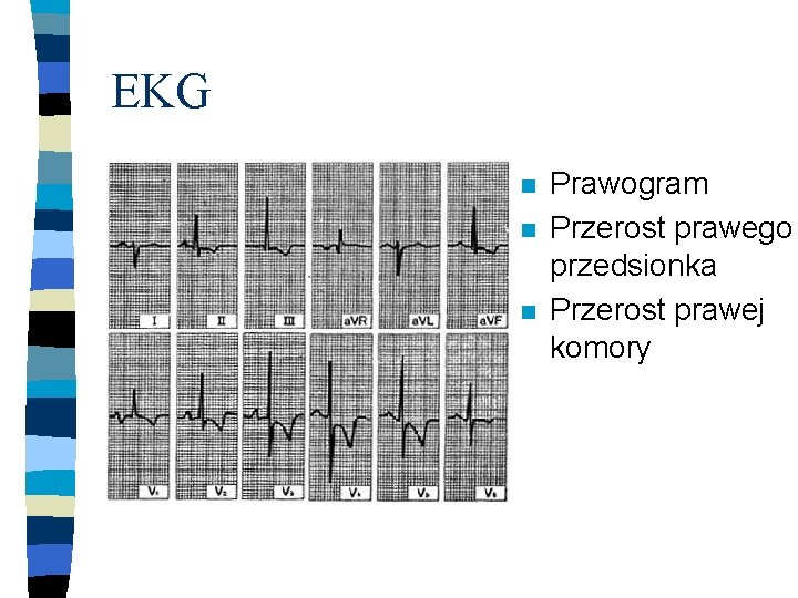 EKG n n n Prawogram Przerost prawego przedsionka Przerost prawej komory 