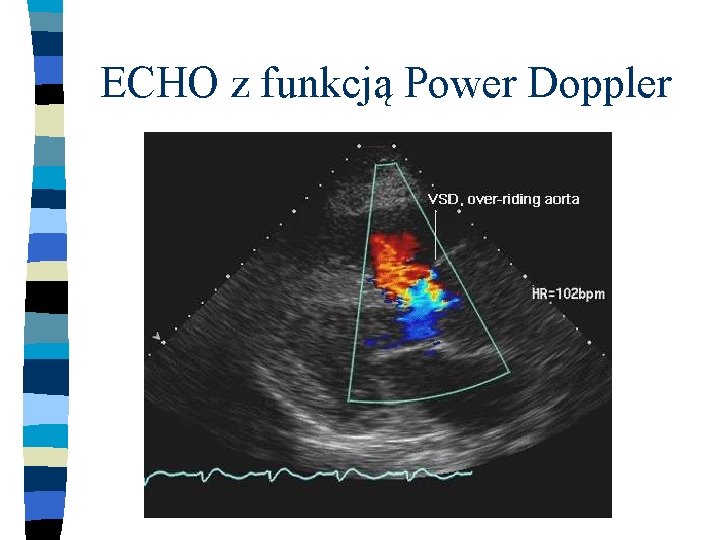 ECHO z funkcją Power Doppler 