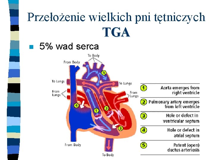 Przełożenie wielkich pni tętniczych TGA n 5% wad serca 
