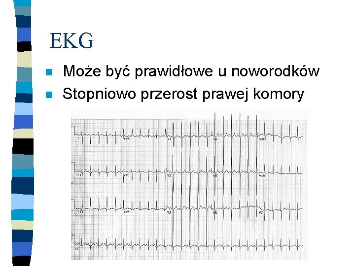 EKG n n Może być prawidłowe u noworodków Stopniowo przerost prawej komory 