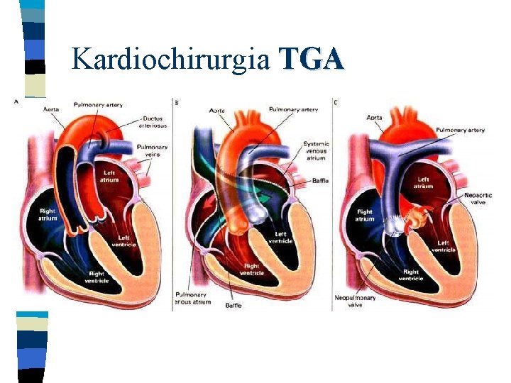 Kardiochirurgia TGA 