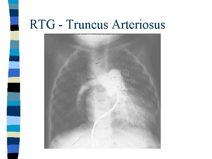 RTG - Truncus Arteriosus 