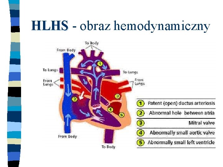 HLHS - obraz hemodynamiczny 