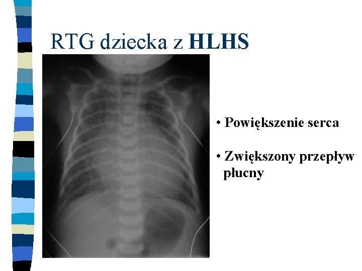 RTG dziecka z HLHS • Powiększenie serca • Zwiększony przepływ płucny 