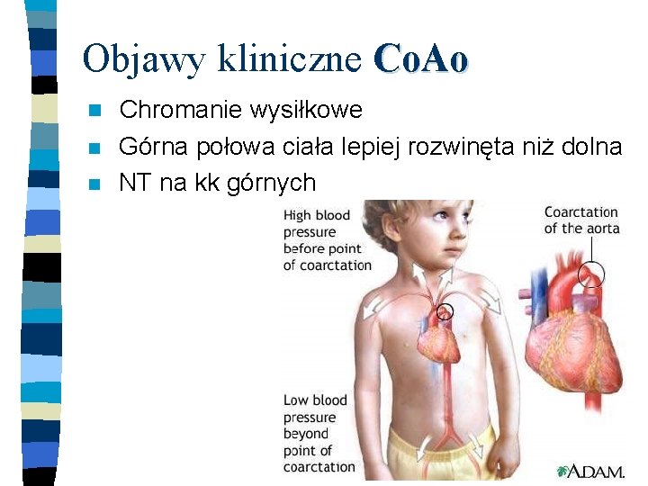 Objawy kliniczne Co. Ao n n n Chromanie wysiłkowe Górna połowa ciała lepiej rozwinęta