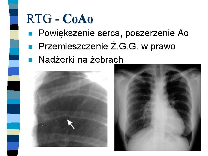 RTG - Co. Ao n n n Powiększenie serca, poszerzenie Ao Przemieszczenie Ż. G.