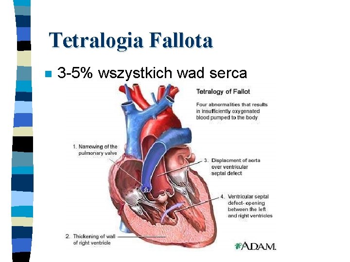 Tetralogia Fallota n 3 -5% wszystkich wad serca 