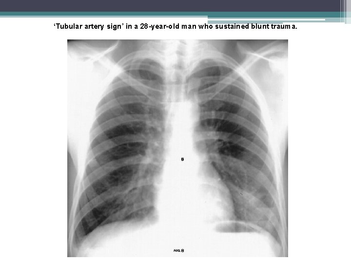 ‘Tubular artery sign’ in a 28 -year-old man who sustained blunt trauma. 