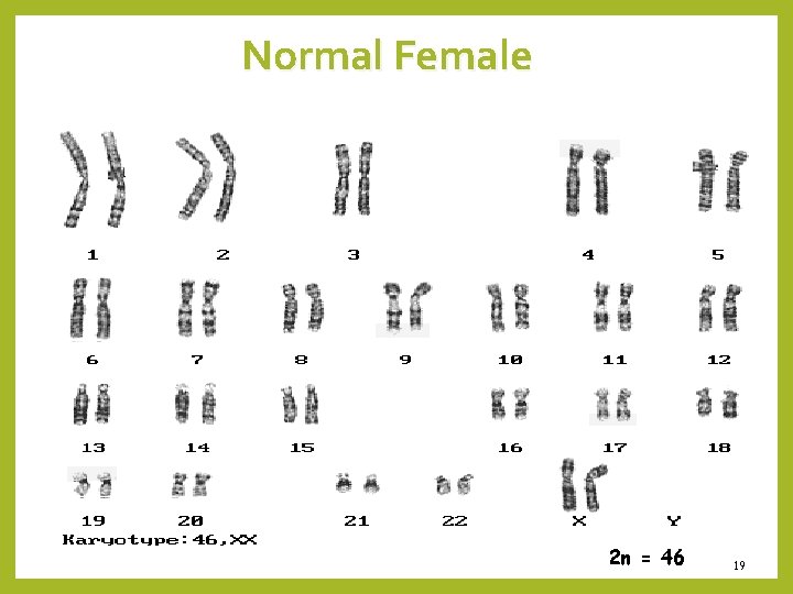 Normal Female 2 n = 46 19 