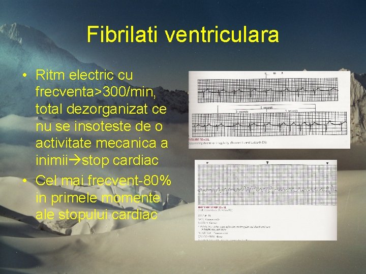 Fibrilati ventriculara • Ritm electric cu frecventa>300/min, total dezorganizat ce nu se insoteste de Fibrilati ventriculara • Ritm electric cu frecventa>300/min, total dezorganizat ce nu se insoteste de