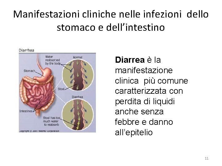 Manifestazioni cliniche nelle infezioni dello stomaco e dell’intestino Diarrea è la manifestazione clinica più