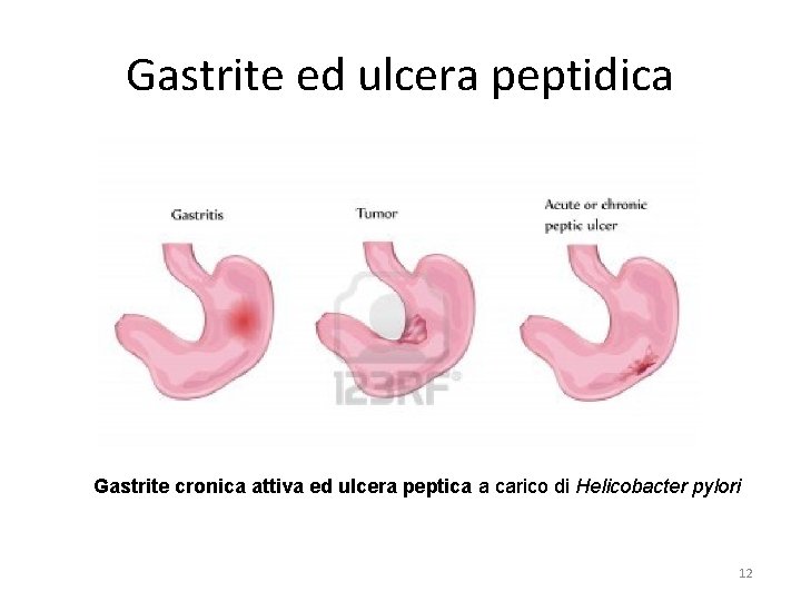 Gastrite ed ulcera peptidica Gastrite cronica attiva ed ulcera peptica a carico di Helicobacter
