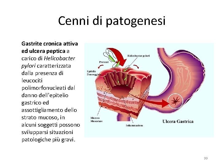 Cenni di patogenesi Gastrite cronica attiva ed ulcera peptica a carico di Helicobacter Cenni di patogenesi Gastrite cronica attiva ed ulcera peptica a carico di Helicobacter