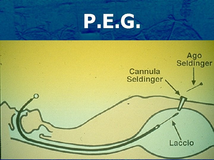 P. E. G. 