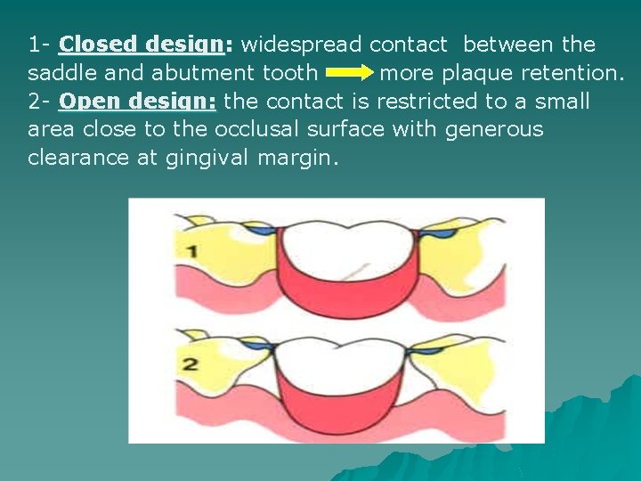 1 - Closed design: widespread contact between the saddle and abutment tooth more plaque