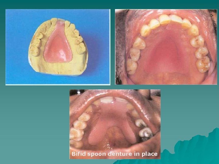 Bifid spoon denture in place 