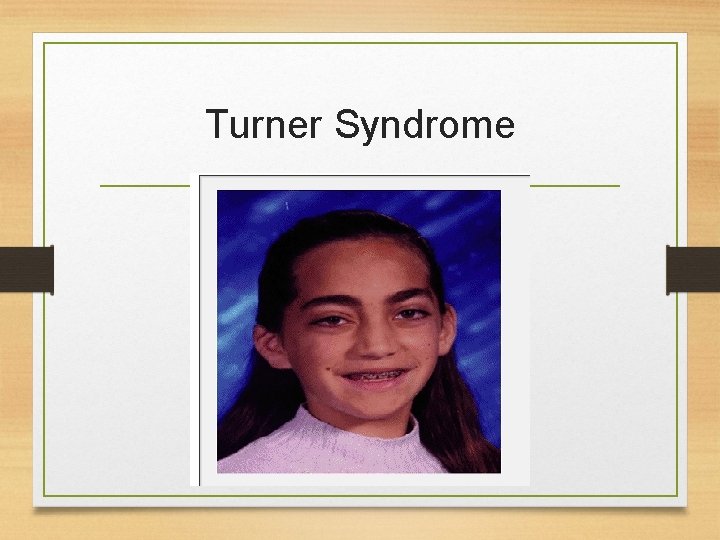 Turner Syndrome 