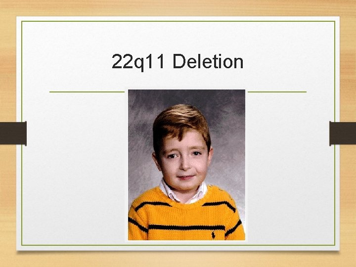 22 q 11 Deletion 