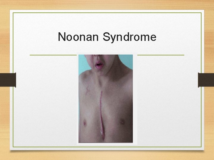 Noonan Syndrome Noonan Syndrome