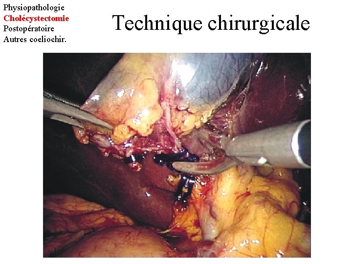 Physiopathologie Cholécystectomie Postopératoire Autres coeliochir. Technique chirurgicale 