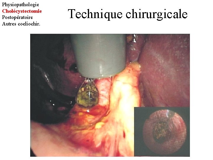 Physiopathologie Cholécystectomie Postopératoire Autres coeliochir. Technique chirurgicale 