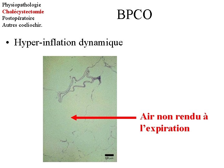 Physiopathologie Cholécystectomie Postopératoire Autres coeliochir. BPCO • Hyper-inflation dynamique Air non rendu à l’expiration