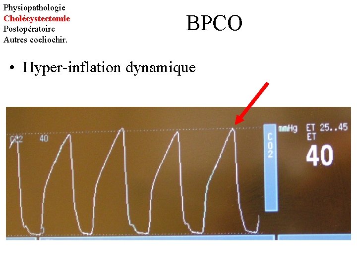 Physiopathologie Cholécystectomie Postopératoire Autres coeliochir. BPCO • Hyper-inflation dynamique 