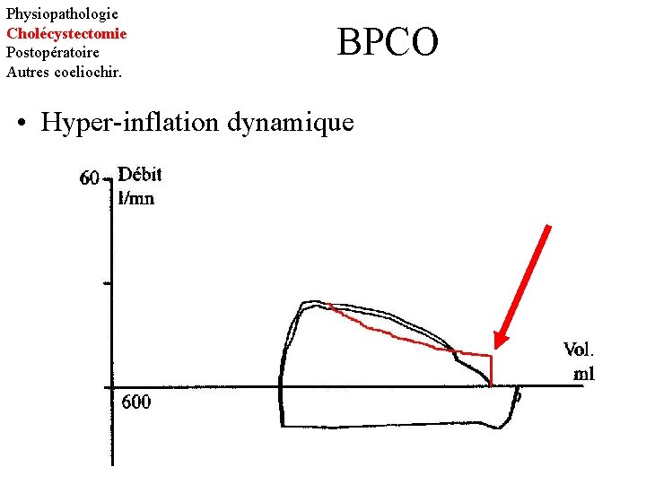 Physiopathologie Cholécystectomie Postopératoire Autres coeliochir. BPCO • Hyper-inflation dynamique 