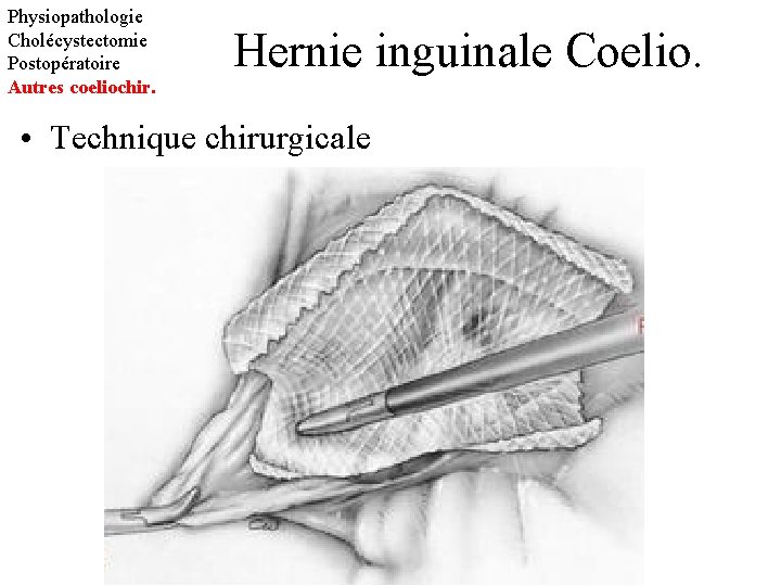 Physiopathologie Cholécystectomie Postopératoire Autres coeliochir. Hernie inguinale Coelio. • Technique chirurgicale 