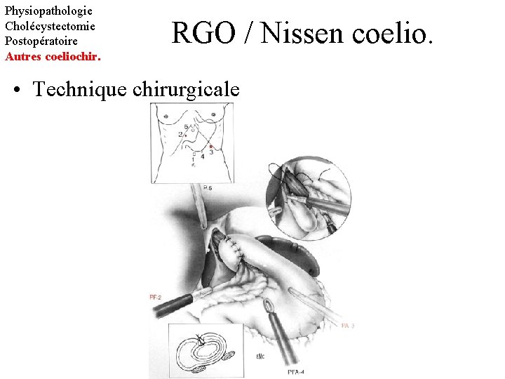 Physiopathologie Cholécystectomie Postopératoire Autres coeliochir. RGO / Nissen coelio. • Technique chirurgicale 