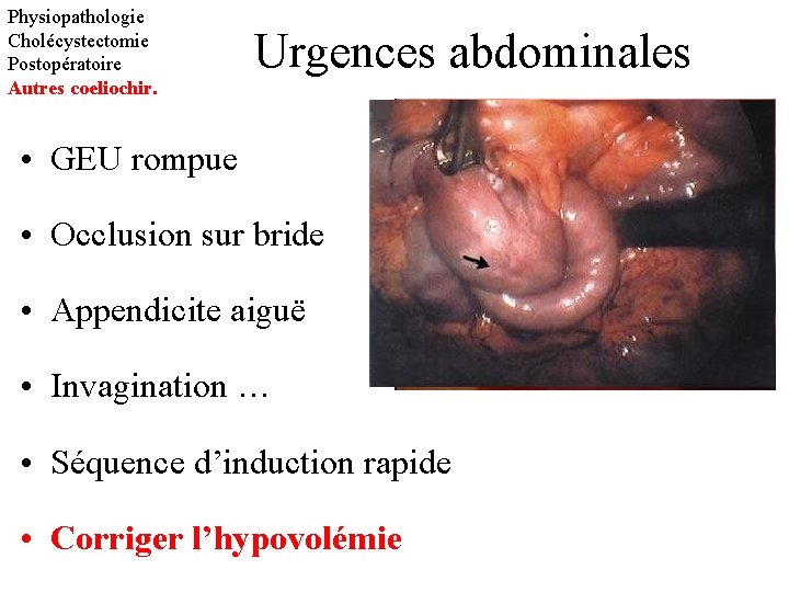 Physiopathologie Cholécystectomie Postopératoire Autres coeliochir. Urgences abdominales • GEU rompue • Occlusion sur bride
