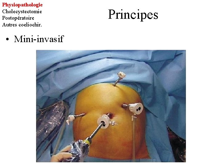 Physiopathologie Cholecystectomie Postopératoire Autres coeliochir. • Mini-invasif Principes 