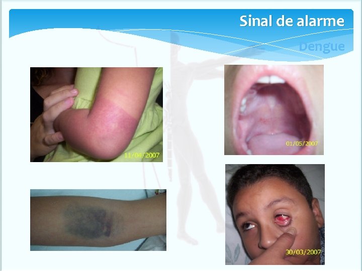 Sinal de alarme Dengue Sinal de alarme Dengue