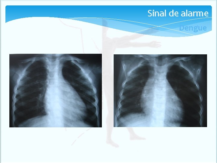 Sinal de alarme Dengue Sinal de alarme Dengue