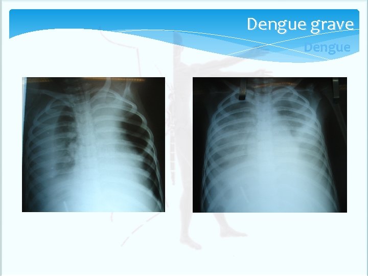 Dengue grave Dengue Dengue grave Dengue