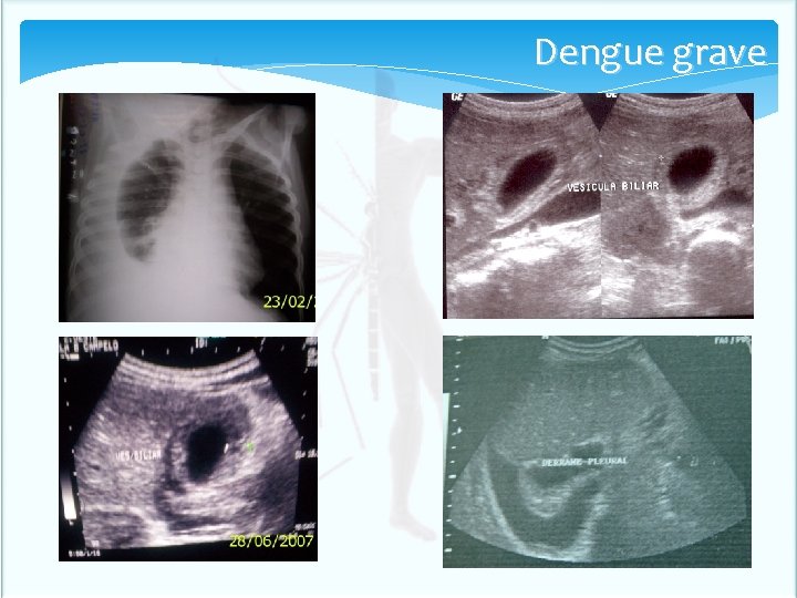 Dengue grave Dengue grave