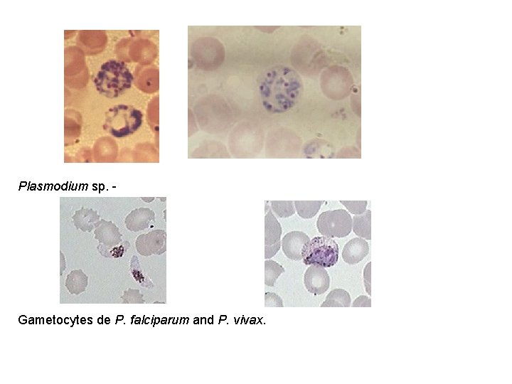 Plasmodium sp. - Gametocytes de P. falciparum and P. vivax. 