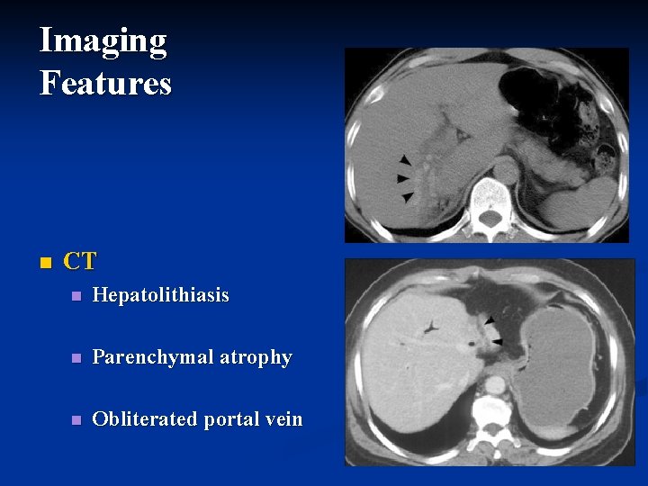 Imaging Features n CT n Hepatolithiasis n Parenchymal atrophy n Obliterated portal vein Imaging Features n CT n Hepatolithiasis n Parenchymal atrophy n Obliterated portal vein