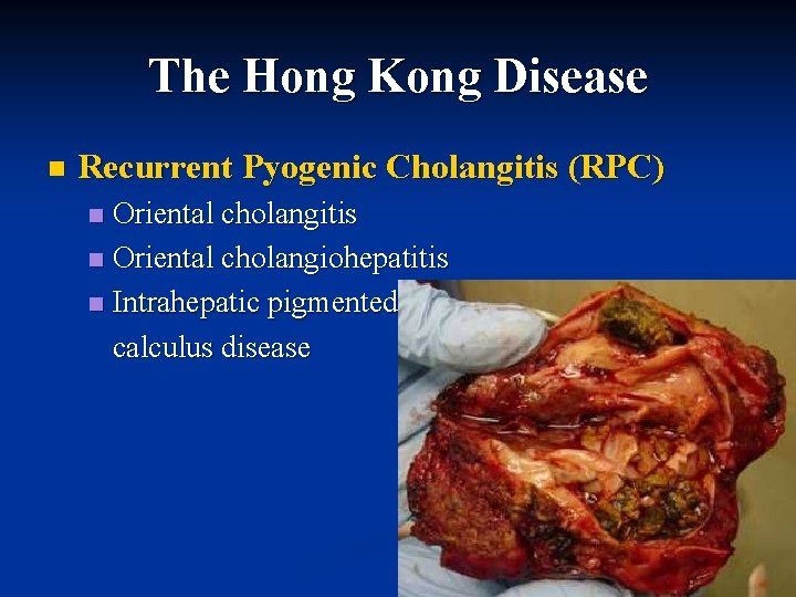The Hong Kong Disease n Recurrent Pyogenic Cholangitis (RPC) Oriental cholangitis n Oriental cholangiohepatitis The Hong Kong Disease n Recurrent Pyogenic Cholangitis (RPC) Oriental cholangitis n Oriental cholangiohepatitis