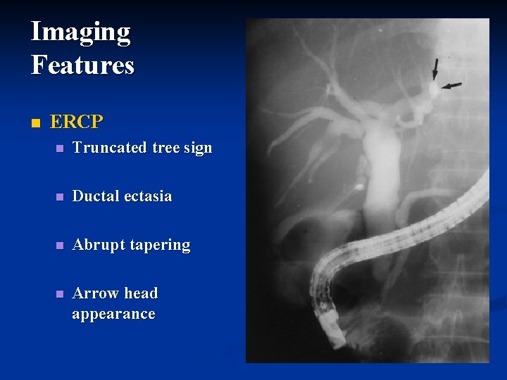 Imaging Features n ERCP n Truncated tree sign n Ductal ectasia n Abrupt tapering Imaging Features n ERCP n Truncated tree sign n Ductal ectasia n Abrupt tapering