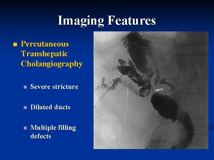 Imaging Features n Percutaneous Transhepatic Cholangiography n Severe stricture n Dilated ducts n Multiple Imaging Features n Percutaneous Transhepatic Cholangiography n Severe stricture n Dilated ducts n Multiple