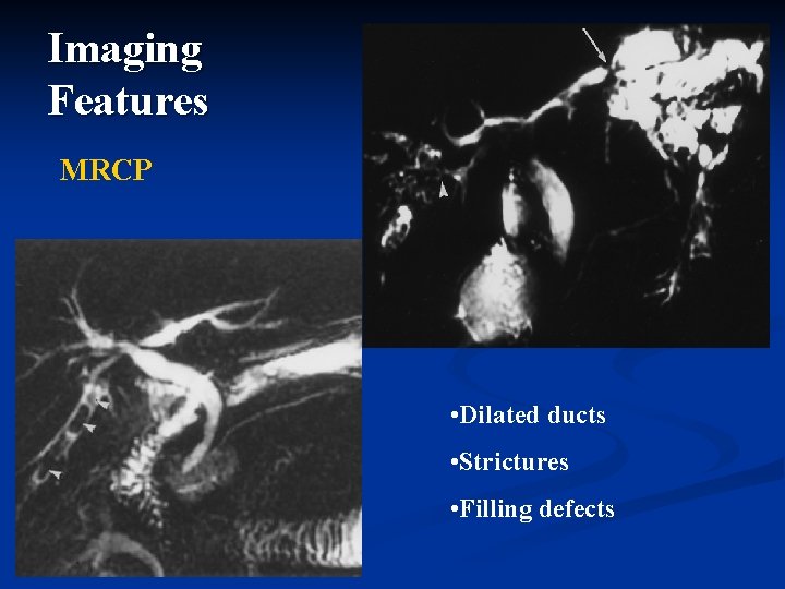 Imaging Features MRCP • Dilated ducts • Strictures • Filling defects Imaging Features MRCP • Dilated ducts • Strictures • Filling defects