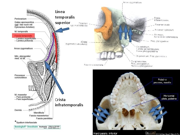 Linea temporalis superior Crista infratemporalis Fossa temporalis 