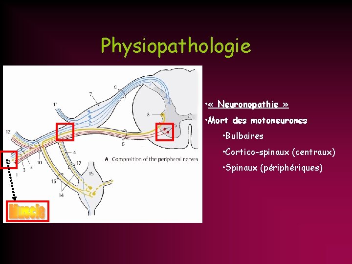 Physiopathologie • « Neuronopathie » • Mort des motoneurones • Bulbaires • Cortico-spinaux (centraux)